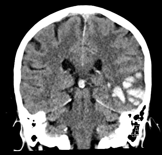 Cerebral venous infarction with hemorrhage (Radiopaedia 65343-74381 Coronal non-contrast 34).jpg