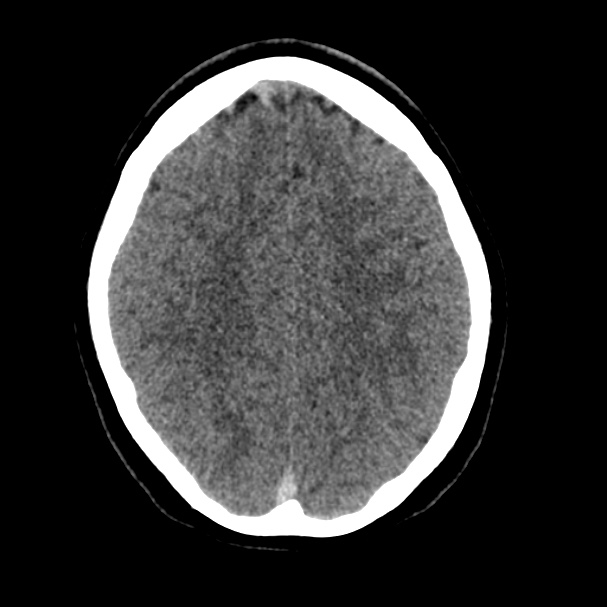 Cerebral venous sinus thrombosis (Radiopaedia 59224-66551 Axial non-contrast 31).jpg