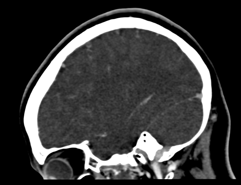 Cerebral venous sinus thrombosis (Radiopaedia 59224-66646 Sagittal C+ delayed 3).jpg