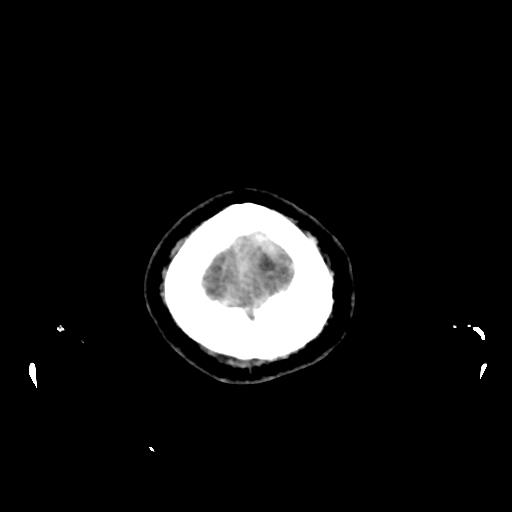 Cerebral venous throbmosis - hemorrhagic venous infarction (Radiopaedia 87318-103613 Axial non-contrast 173).jpg