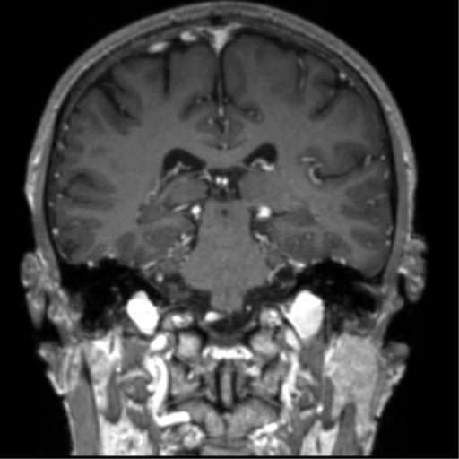 Cerebral venous thrombosis (Radiopaedia 38392-40469 Coronal T1 C+ 37).png