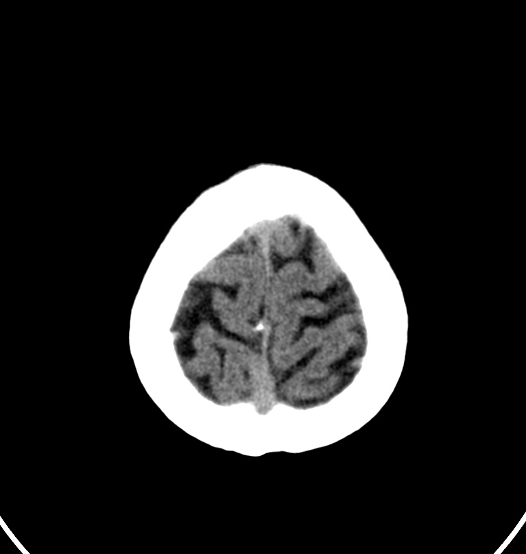 Cerebral venous thrombosis - CT only (Radiopaedia 41031-43778 Axial non-contrast 3).jpg