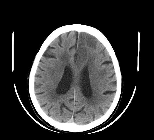 File:Cerebrovascular accident (Radiopaedia 11291-32128 Axial non-contrast 1).jpg