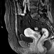 File:Cervical adenocarcinoma (Radiopaedia 65011-73985 E 17).jpg