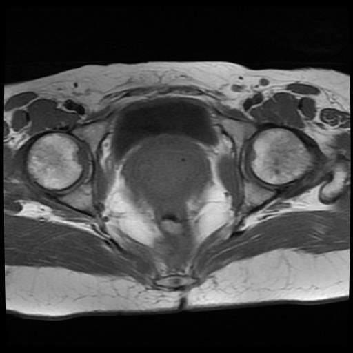 File:Cervical cancer (Radiopaedia 62991-71413 Axial T1 14).jpg