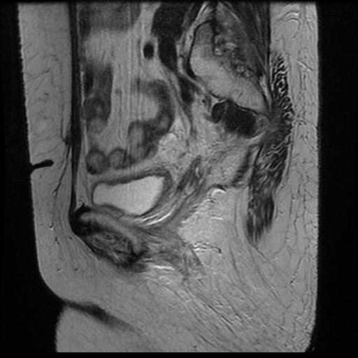 File:Cervical carcinoma (Radiopaedia 70924-81132 Sagittal T2 7).jpg