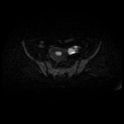 File:Cervical carcinoma (Radiopaedia 88010-104555 Axial DWI 37).jpg