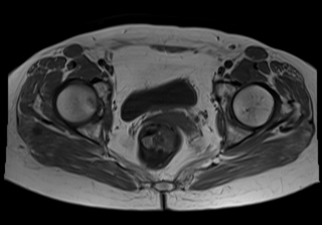 File:Cervical carcinoma (Radiopaedia 88312-104943 Axial T1 15).jpg
