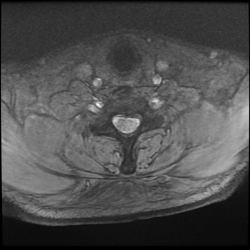 Cervical disc extrusion (Radiopaedia 59074-66364 F 47).jpg
