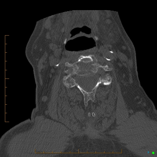Cervical spine fracture - ankylosing spondylitis (Radiopaedia 76835-88706 Axial bone window 111).jpg