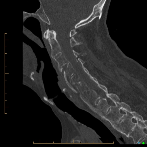 Cervical spine fracture - ankylosing spondylitis (Radiopaedia 76835-88706 Sagittal bone window 64).jpg