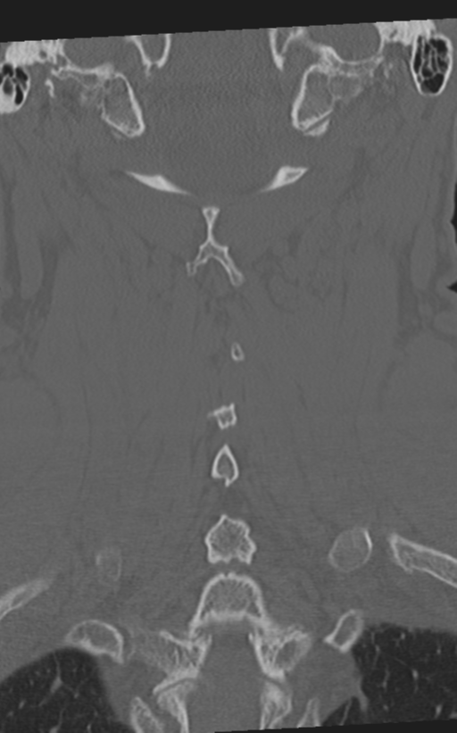 Cervical spine fractures with vertebral artery dissection (Radiopaedia 53296-59268 Coronal bone window 51).png
