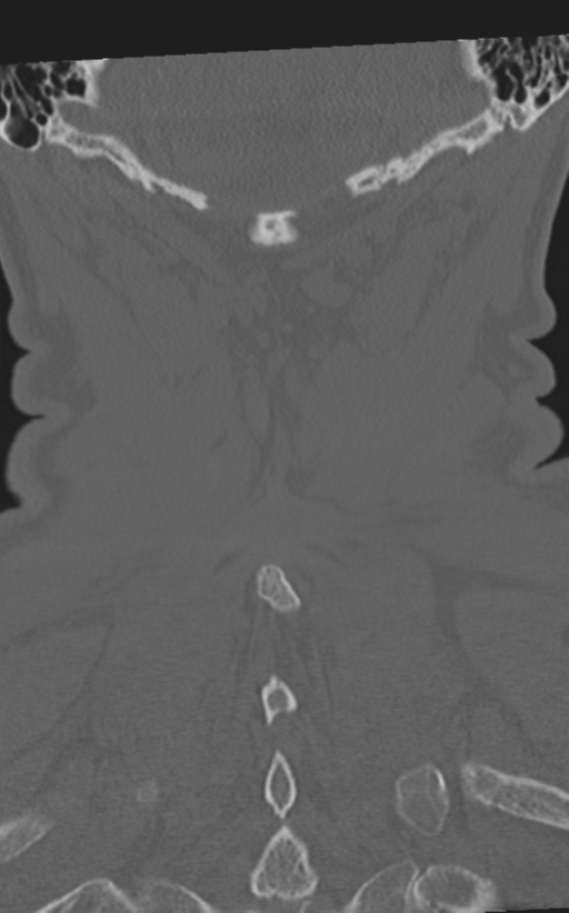 Cervical spine fractures with vertebral artery dissection (Radiopaedia 53296-59268 Coronal bone window 59).png