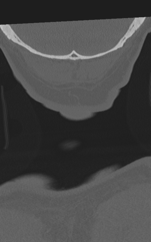 Cervical spine fractures with vertebral artery dissection (Radiopaedia 53296-59268 Coronal bone window 79).png