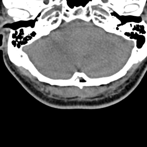 Cervical spondylodiscitis (Radiopaedia 28057-29489 Axial non-contrast 5).jpg