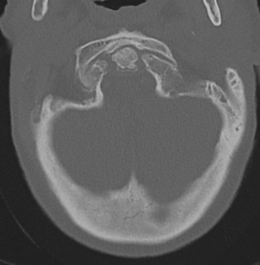 File:Cervical spondylolysis (Radiopaedia 49616-54811 Axial bone window 10).png