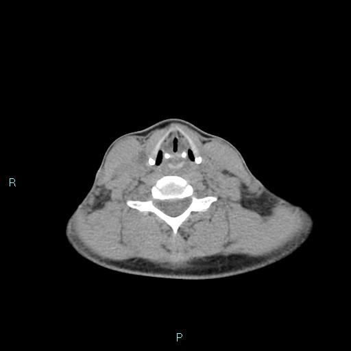 File:Cervical thymic cyst (Radiopaedia 88632-105335 Axial non-contrast 50).jpg