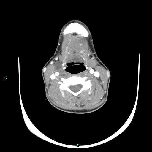 Cervical thymic cyst (Radiopaedia 88632-105335 B 63).jpg
