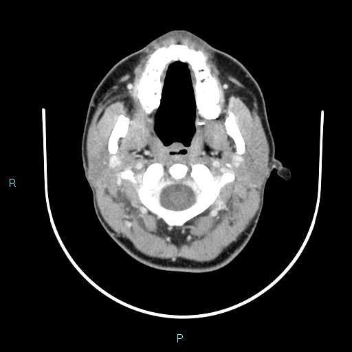 Cervical thymic cyst (Radiopaedia 88632-105335 C 93).jpg