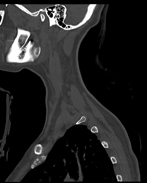 Cervical tuberculous spondylitis (Radiopaedia 39149-41365 Sagittal bone window 9).png