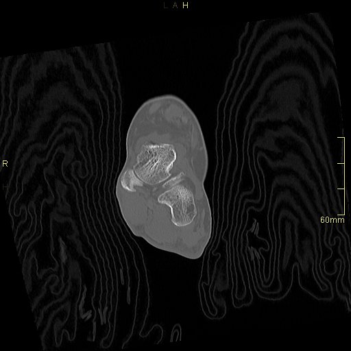 Chaput tubercle fracture (Radiopaedia 80319-93956 Coronal non-contrast 28).jpg