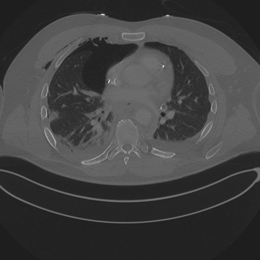 File:Chest multitrauma - aortic injury (Radiopaedia 34708-36147 Axial bone window 161).png