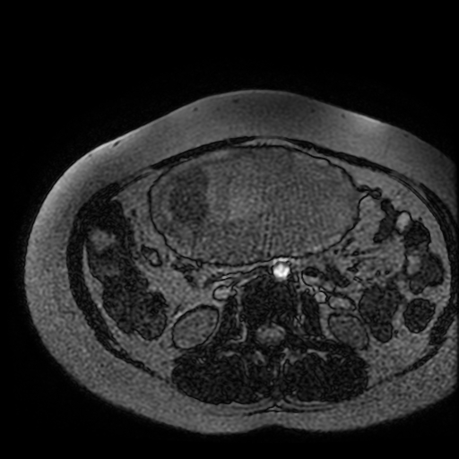 Chiari II malformation - fetal MRI (Radiopaedia 68099-77581 Axial Fiesta 1).jpg