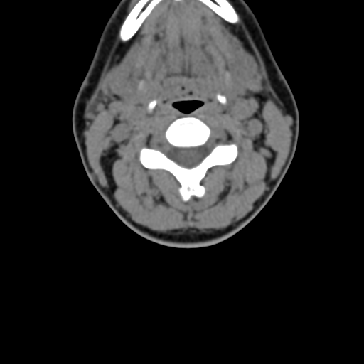 File:Chiari I malformation and obstructive hydrocephalus (Radiopaedia 41185-43981 D 48).png