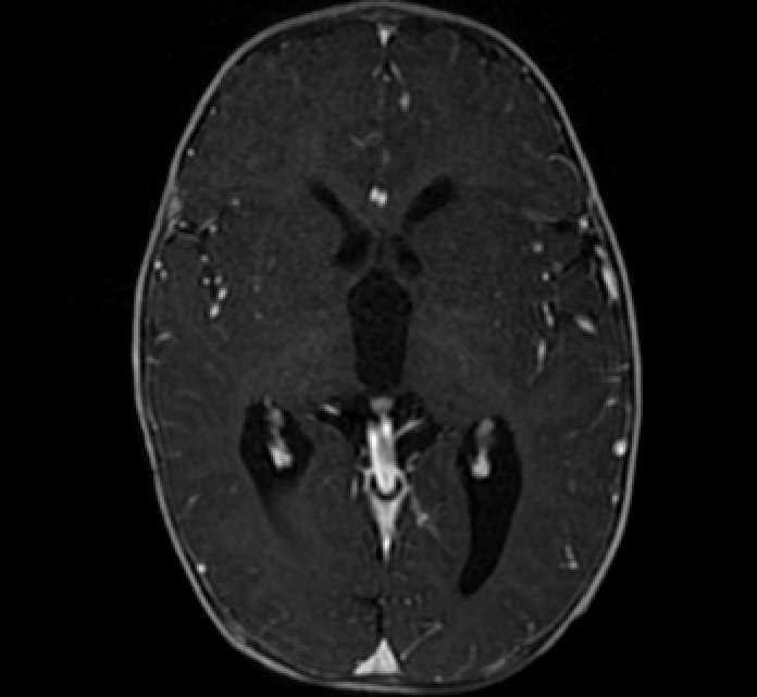 Chiasmatic-hypothalamic glioma (Radiopaedia 90079-107252 Axial T1 C+ 42).jpg