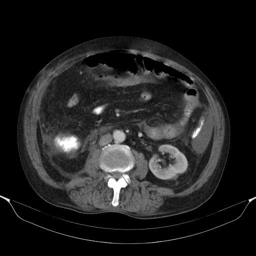 File:Cholangitis and abscess formation in a patient with cholangiocarcinoma (Radiopaedia 21194-21100 A 27).jpg
