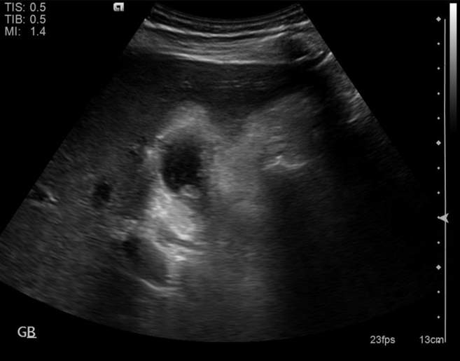 File:Cholecystitis - perforated gallbladder (Radiopaedia 57038-63913 A 10).jpg