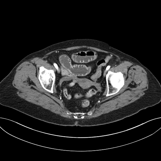 Cholecystoduodenal fistula due to calculous cholecystitis with gallstone migration (Radiopaedia 86875-103077 A 65).jpg