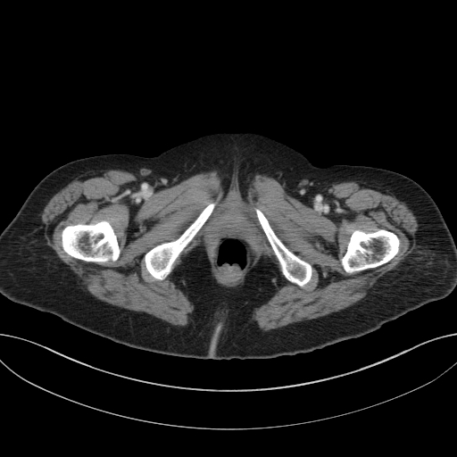 Cholecystoduodenal fistula due to calculous cholecystitis with gallstone migration (Radiopaedia 86875-103077 D 85).jpg