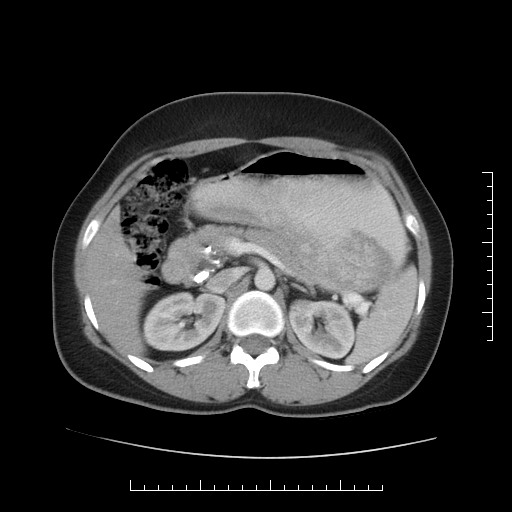 File:Choledochal cyst with chronic calcific pancreatitis (Radiopaedia 18245-18061 A 11).png