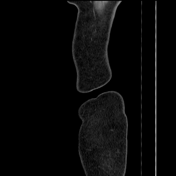 Choledocholithiasis on CT and MRI (Radiopaedia 24825-25087 D 1).jpg
