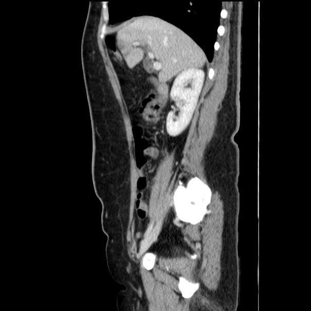 Choledocholithiasis on CT and MRI (Radiopaedia 24825-25087 D 23).jpg