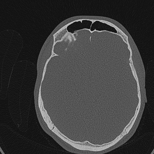 Cholesteatoma (Radiopaedia 70429-80529 Axial bone window 134).jpg