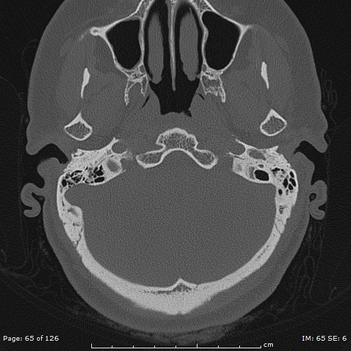 Cholesteatoma - external auditory canal (Radiopaedia 88452-105096 Axial bone window 28).jpg