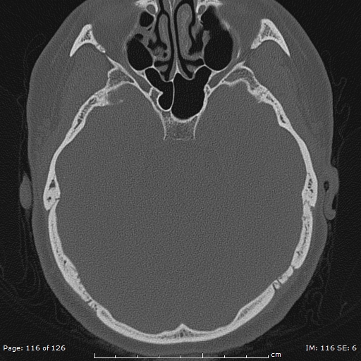 Cholesteatoma - external auditory canal (Radiopaedia 88452-105096 Axial bone window 79).jpg
