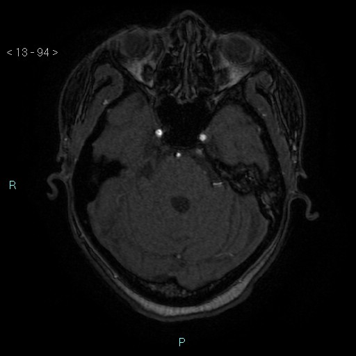 Cholesterol granuloma of the petrous apex (Radiopaedia 64358-73140 Axial TOF 3D 46).jpg