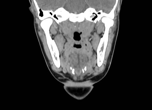 Chondroblastic osteosarcoma (Radiopaedia 67363-76741 D 60).jpg