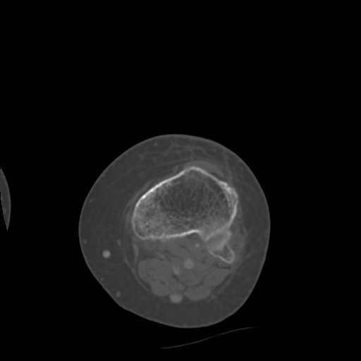 Chondrosarcoma - femur (Radiopaedia 64187-72954 Axial bone window 63).jpg