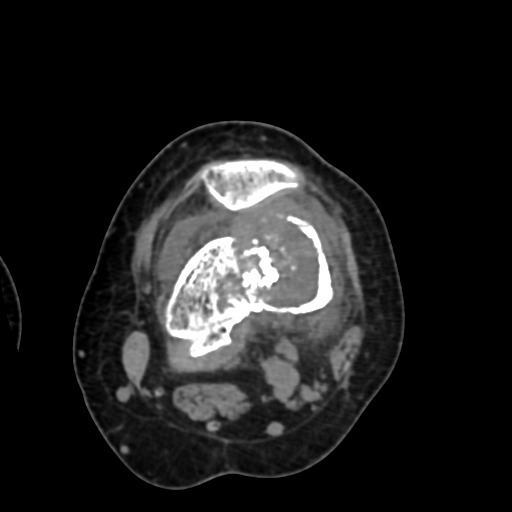 Chondrosarcoma - femur (Radiopaedia 64187-72954 Axial non-contrast 38).jpg
