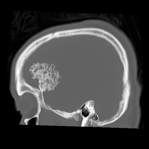 File:Chondrosarcoma - sphenoid wing (Radiopaedia 58259-67828 Sagittal bone window 23).jpg
