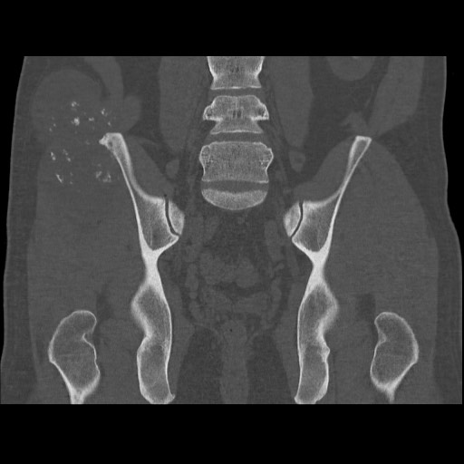 Chondrosarcoma of iliac wing (Radiopaedia 63861-72599 Coronal bone window 72).jpg