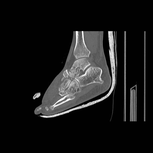 File:Chopart fracture (Radiopaedia 12386-12650 Sagittal bone window 11).jpg
