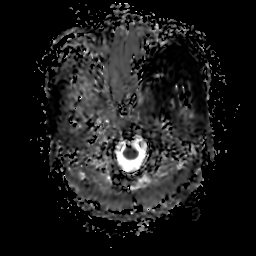 File:Chordoid glioma of third ventricle (Radiopaedia 91612-109340 Axial ADC 3).jpg