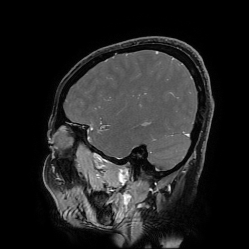 Chordoid glioma of third ventricle (Radiopaedia 91612-109340 F 156).jpg