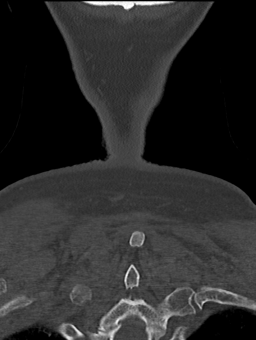 Chordoma (C4 vertebra) (Radiopaedia 47561-52188 Coronal bone window 63).png