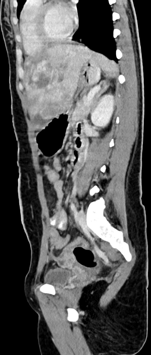 Choriocarcinoma liver metastases (Radiopaedia 74768-85766 C 82).jpg